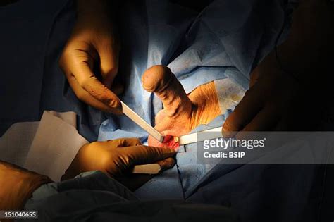 phalloplasty healed results|Phalloplasty: What Is It, How It Works, Recovery, Cost .